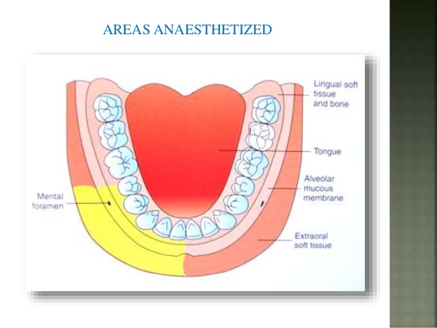 Maxillary Dental Nerve Block