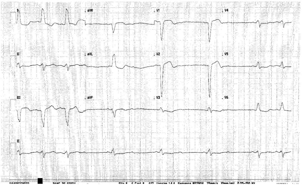 EKG of the Week (15OCT20) – EM Ninja