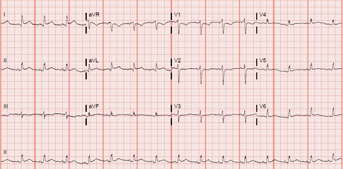 EKG of the Week (22OCT20) – EM Ninja